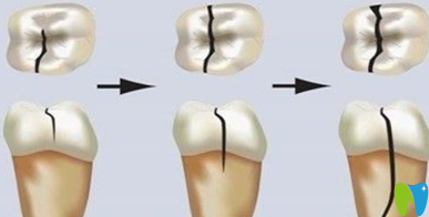 <!--<i data=20240703-sp></i>-->華科普：大牙裂了一道縫該怎么辦