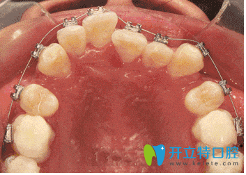 自鎖托槽矯正牙齒進行中