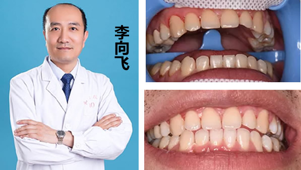 冷光美白牙齒多少錢(qián) 李向飛口腔680元的價(jià)格你確定要錯(cuò)過(guò)嗎