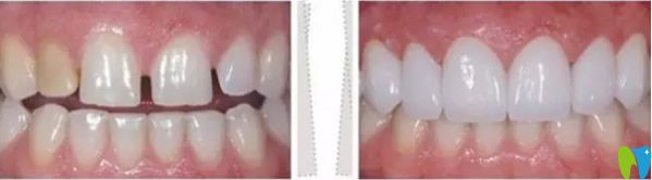 李向飛口腔瓷貼面修復(fù)效果