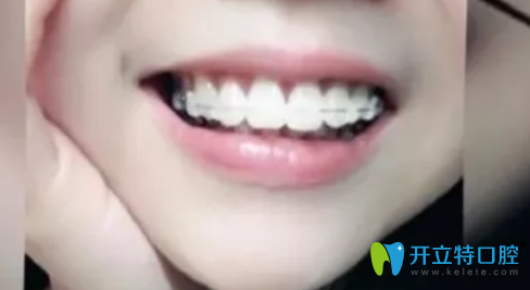 維樂口腔帶牙套1年10個月照片