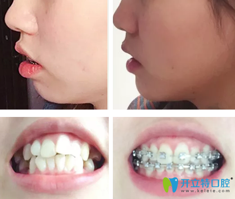 齙牙怎么矯正？曬泰安光彩口腔鋼絲矯正齙牙1-10個(gè)月變化圖