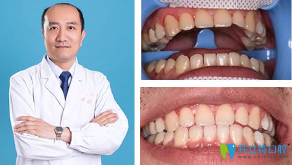 石家莊李向飛口腔冷光美白效果案例