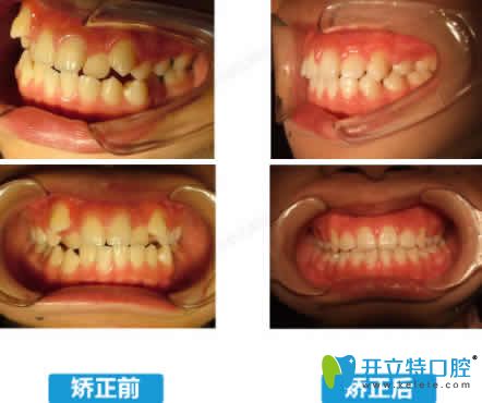 泉州維樂(lè)口腔黃鴻進(jìn)牙齒矯正前后效果對(duì)比圖