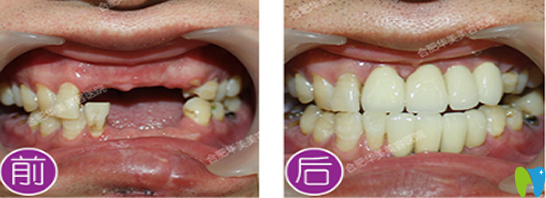 合肥華美口腔好不好？看華美種植牙案例效果展示