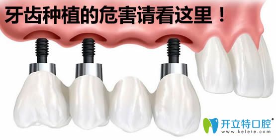 種植牙的危害有哪些？薛國初醫(yī)生來分析牙齒種植的利與弊