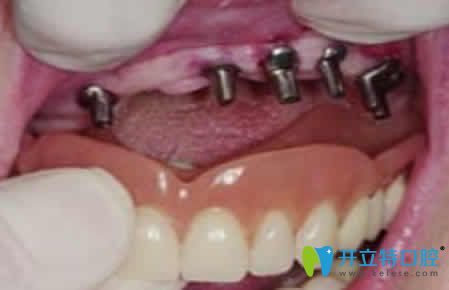 套筒冠義齒安裝圖