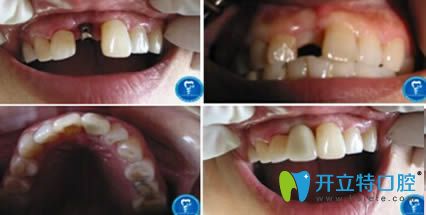 青島天皓口腔門診趙軍醫(yī)生種植牙案例效果對比圖