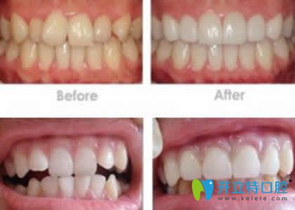 新疆凱樂(lè)口腔趙艷隱形牙齒矯正效果圖