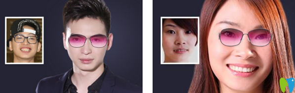 華美口腔牙列不齊、齙牙矯正效果