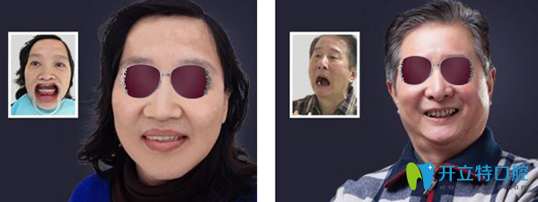 汕頭華美口腔種植牙效果