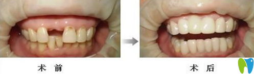 英博口腔門牙缺失種植牙案例對(duì)比圖