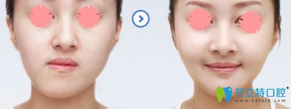 成都西區(qū)口腔科偏頜矯正帶牙套矯正前后對(duì)比效果