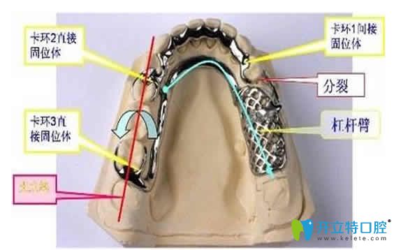 分享2024可摘局部義齒優(yōu)缺點(diǎn)及活動(dòng)假牙價(jià)格