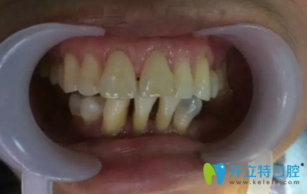 分享媽媽在上海英博口腔做All-on-4即刻種植牙的感受和體驗(yàn)