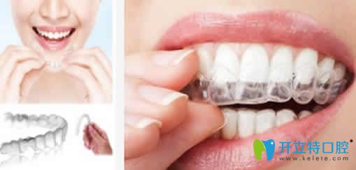 泉州維樂(lè)口腔楊華介紹隱形牙齒矯正優(yōu)勢(shì)