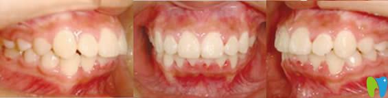 青島天皓口腔11歲孩子牙齒正畸后照片