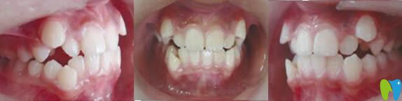 青島天皓口腔牙齒矯正前照片