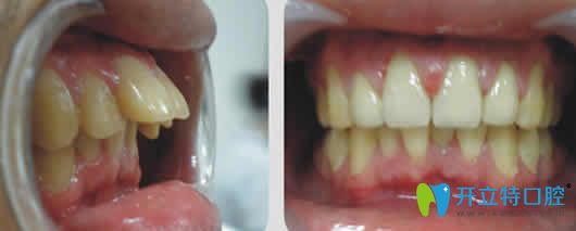 新疆凱樂口腔齙牙矯正前后效果對比圖