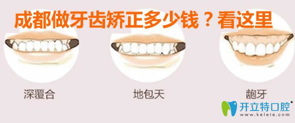 成都做牙齒矯正多少錢(qián)?看時(shí)代天使/隱適美/正雅牙套價(jià)格表