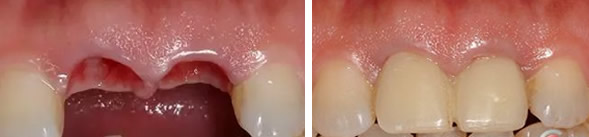 青島馬瀧齒科張晗博士種牙怎么樣 門牙折斷+牙缺失修復(fù)效果