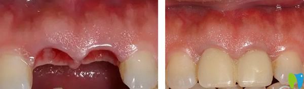 馬瀧齒科門牙種植修復(fù)效果案例
