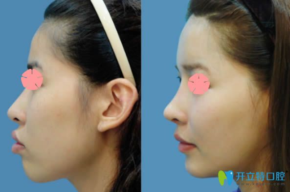 成都市西區(qū)口腔科中度雙頜前突矯正側臉前后對比照