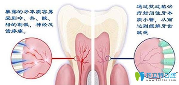 急性牙髓炎怎么治療搶先看 錯過治療讓你后悔莫及