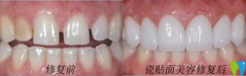 開(kāi)立特網(wǎng)站牙齒貼面美容修復(fù)前后對(duì)比照