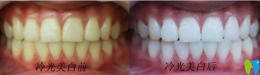 開(kāi)立特牙齒美容修復(fù)前后對(duì)比圖