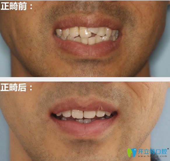 成都西區(qū)口腔28歲矯正牙齒前后對(duì)比照