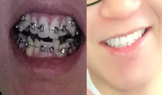 花2.6萬在合肥華美口腔做了鋼絲矯正 丑牙變美牙就這么簡(jiǎn)單