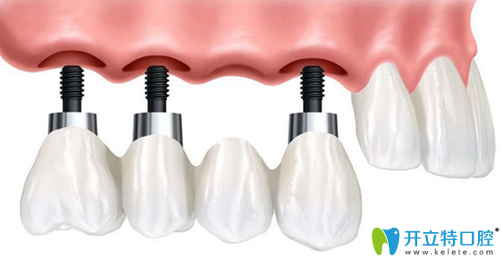 種植牙到底好不好，該不該做