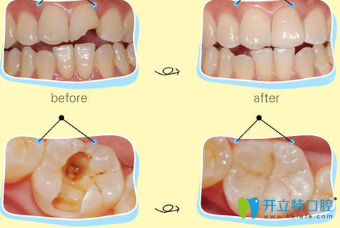 華美楊松補(bǔ)牙治療術(shù)前術(shù)后對比案例