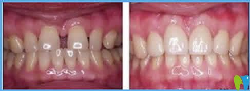 牙齒縫隙大矯正前后效果對(duì)比圖