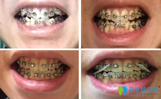 合肥華美口腔牙齒矯正2年間變化過(guò)程圖展示 合肥華美口腔牙齒矯正2年間變化過(guò)程圖展示