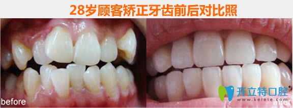 哈爾濱拜博口腔28歲隱適美矯正牙齒前后對比后效果照