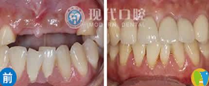 寧波現(xiàn)代口腔陳敬達(dá)種植牙案例效果圖