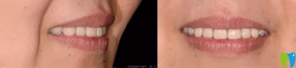 美萊口腔牙齒缺失種植牙恢復(fù)效果圖