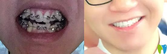 在合肥華美口腔做牙齒矯正前后的對(duì)比圖 在合肥華美口腔做牙齒矯正前后的對(duì)比圖