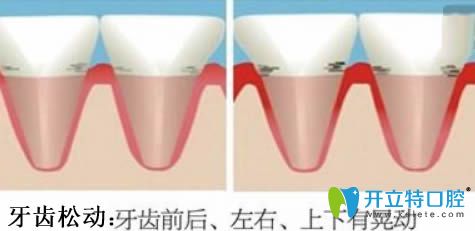 牙齒松動(dòng)怎么治療?提供多條有效的治療及預(yù)防方法