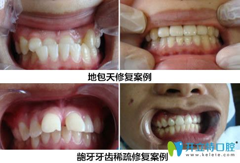 趙艷牙齒修復(fù)案例