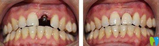 即刻種植牙代表案例