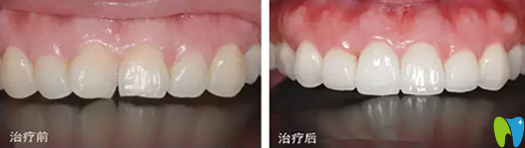 嘉興曙光口腔牙齒美容冠修復(fù)治療前后對(duì)比圖 嘉興曙光口腔牙齒美容冠修復(fù)治療前后對(duì)比圖