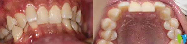 福州登特口腔牙齒矯正前
