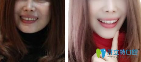 從重慶樂(lè)樂(lè)欣段斌牙齒矯正案例來(lái)看牙齒正畸對(duì)臉型的影響