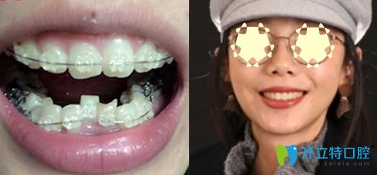  重慶整牙哪家？看重慶樂(lè)樂(lè)欣口腔牙齒矯正真人案例