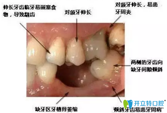 拔牙后鑲牙有沒有時間？