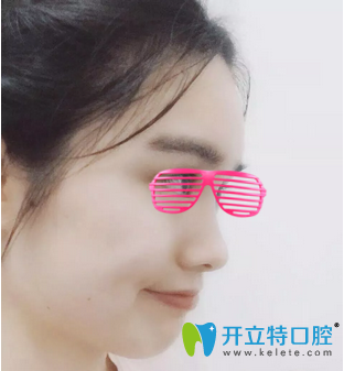 矯正牙齒12個(gè)月<span style=