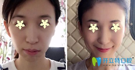 樂樂欣口腔段斌骨性齙牙隱形矯正案例